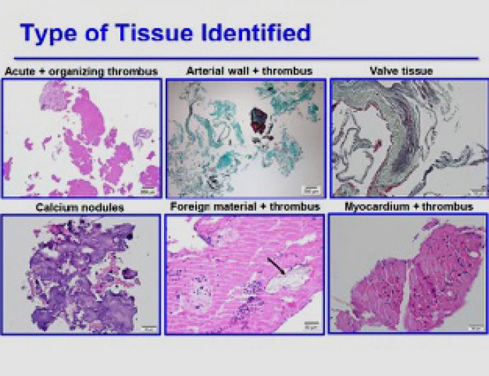 TAVR is Here and Mainstream With the Risk of Stroke